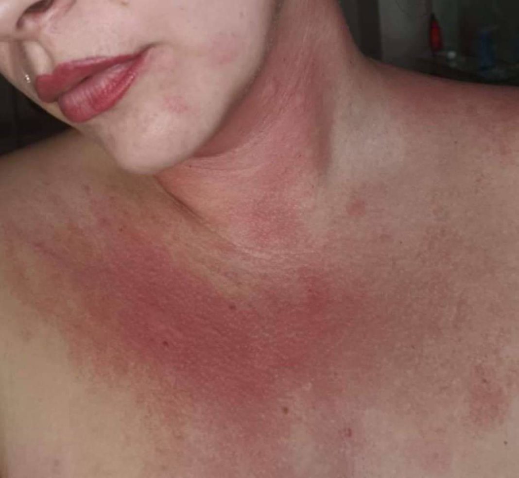 Jade Butlin: Painful and very itchy rash, from processionary caterpillars' hairs