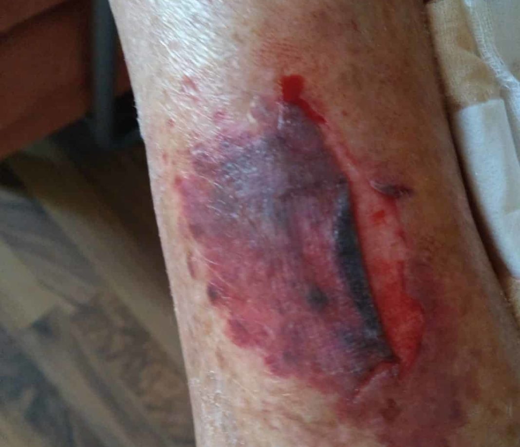 Kathleen McMillan suffered shin injury after cyclist ran into her.